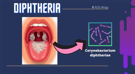 Diphtheria डिप्थीरिया Causes Pathogenesis Signs And Symptoms