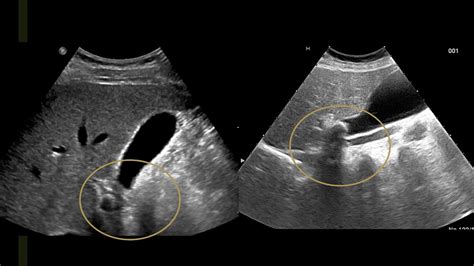 Focused Gallbladder Ultrasound Youtube