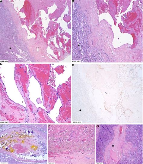 Frontiers Rare Adrenal Cavernous Hemangioma A Case Report
