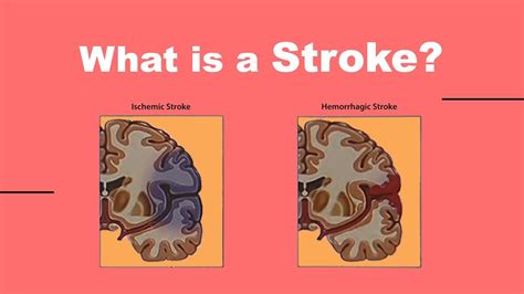 What Is A Stroke Youtube