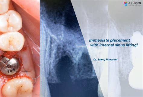 Immediate Placement With Internal Sinus Lifting Megagen Implant