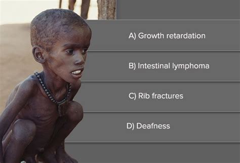 Malnutrition Causes Complications And Treatments