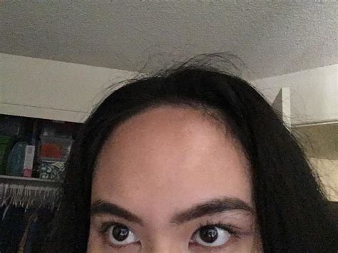 Whats The White Patch On My Upper Right Forehead Skin Concern R