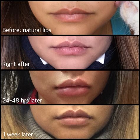 List 97 Background Images Do Lip Fillers Ruin Your Lips Latest