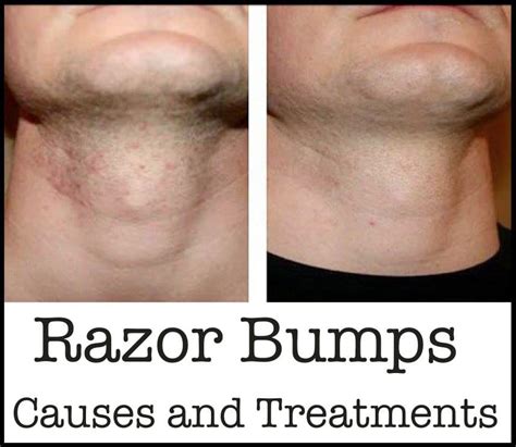 Razor Bumps Causes And Treatments Instiks