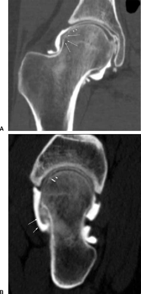 Figure 1 From Mr And Ct Arthrography Of The Hip Llopis Semantic Scholar