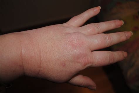 Swollen Painfull Hands Crohns Or Medication Crohns Fibromyalgia