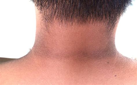 Black Neck Symptoms Causes And Treatments Skinkraft