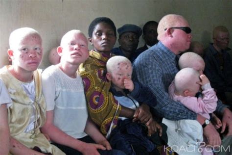 Malawi Des Albinos Candidats Aux élections Une Grande Première