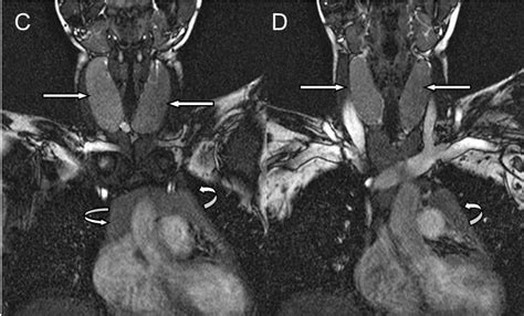 Thymic Hyperplasia In A Patient With Graves Disease Mri Findings