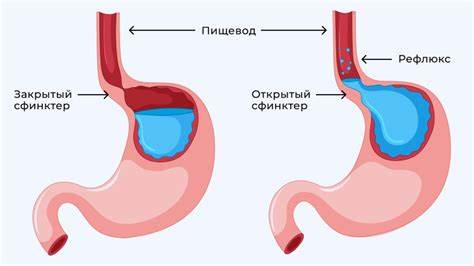 Неэрозивный рефлюкс эзофагит диета Неэрозивный рефлюкс-эзофагит: признаки и симптомы, причины Неэрозивный рефлюкс-эзофагит: признаки и симптомы, причины Неэрозивный рефлюкс эзофагит диета