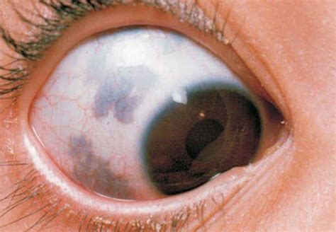 Black Spot On The Eye Área Oftalmológica Avanzada