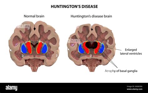 Huntingtons Gene Hi Res Stock Photography And Images Alamy