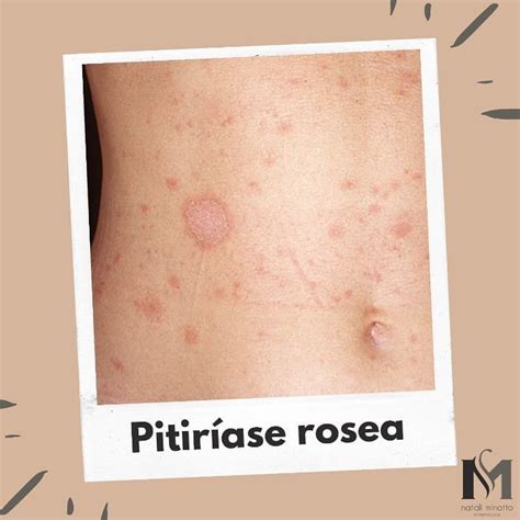 Aprender Sobre 55 Imagem Pitiríase Rosea Foto Vn