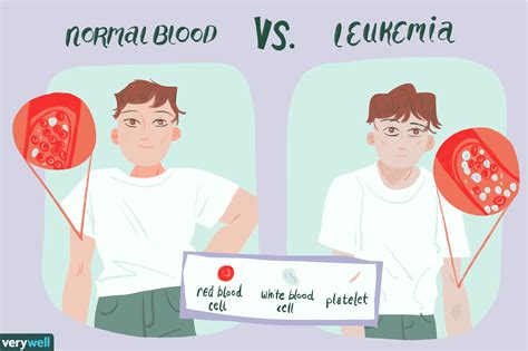 How To Check For Leukemia Elevatorunion6