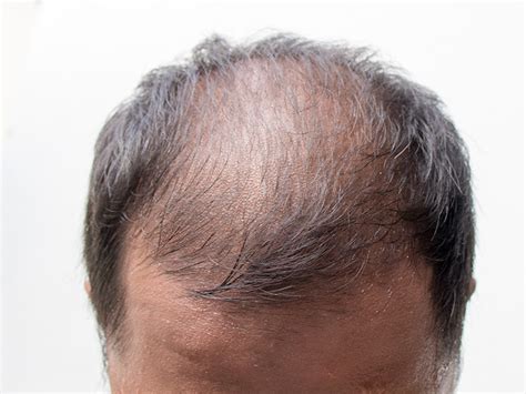 Male Pattern Baldness Hair Restoration Toronto Hair Transplant Toronto