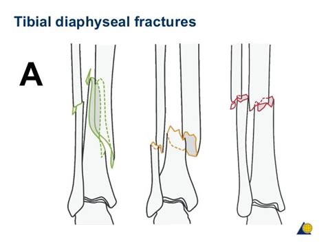 Icd 10 Code For Right Distal Fibula Fracture Nondisplaced