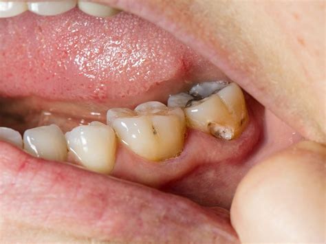 Untreated Tooth Decay Common In Us Adults Cdc Says