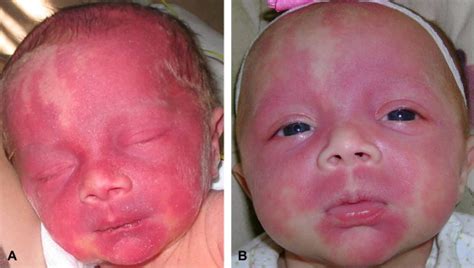 Physiologic Changes In Vascular Birthmarks During Early Infancy