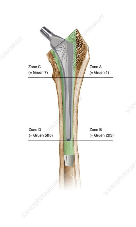 Prosthetic Hip Joint And Gruen Zones Stock Image C0166777 Science