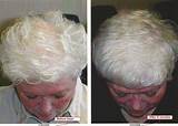 Hair Loss Treatment Chicago Images