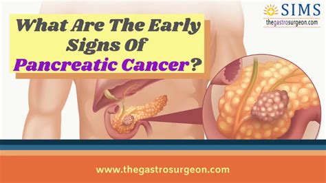 What Are The Signs Of Advanced Pancreatic Cancer Early Signs And Symptoms Of Pancreatic Cancer