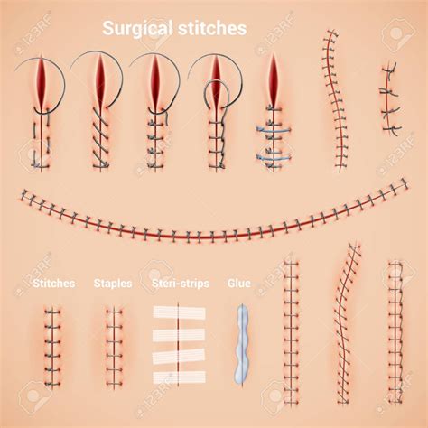 Surgical Suture Stitches Realistic Set Of Stitching Methods And