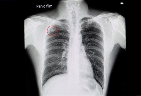 nodules aux poumons symptômes – nodule pulmonaire de 12 mm – F88 F99