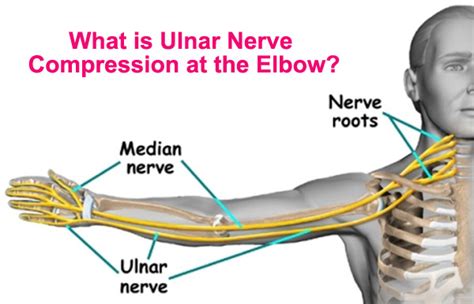What Is Ulnar Nerve Compression At The Elbow Chronic Body Pain