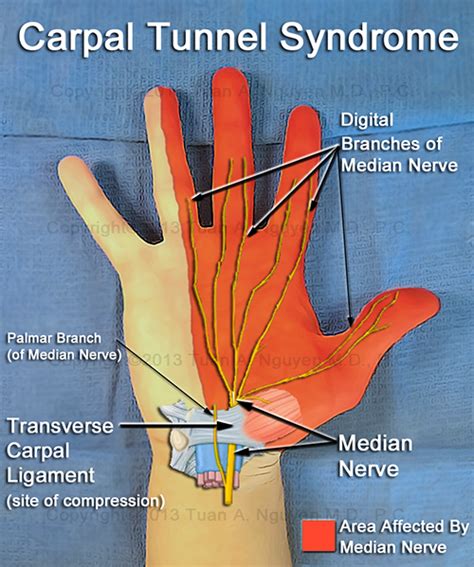 Pinched Nerve In Finger Carpal Tunnel The Carpal Solu