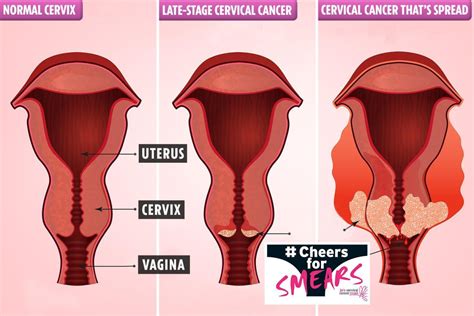 The following are cervical cancer symptoms that you shouldn't ignore. The 5 early signs you could have 'silent killer' cervical ...