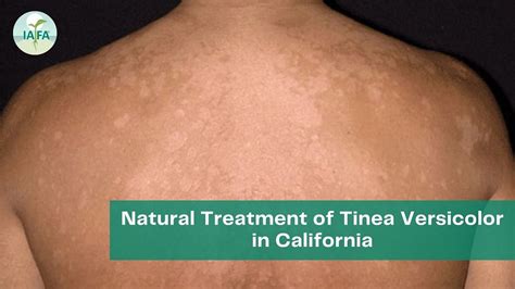 Natural Treatment Of Tinea Versicolor In California