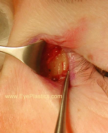 Fetal alcohol syndrome epicanthal folds flat nasal bridge small palpebral fissures upturned nose. Treatment of blocked tear duct | obstrution | Lacrimal ...
