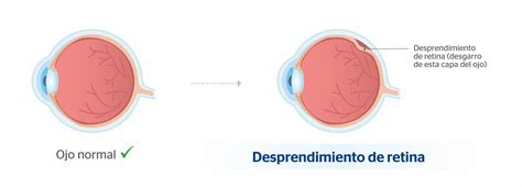 desprendimiento de retina síntomas y tratamiento clínica baviera