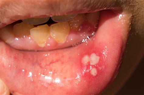 Mouth Ulcer Or Canker Sore Or Aphthous Stomatitis Or Aphthous Ulcer