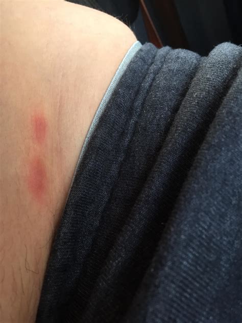Do These Look Like Bed Bug Bites I Have Two More Below My Waist Band