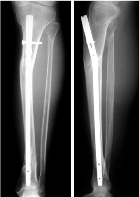 Anterior Tibial Stress Fracture