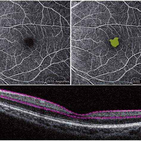 Optical Coherence Tomography Angiography OCTA Images Of Superficial