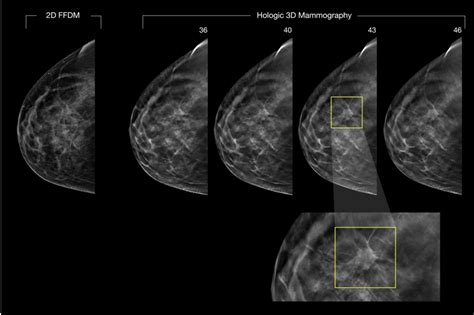 3d Mammography Use Is On The Rise And May Improve Breast Cancer Detection