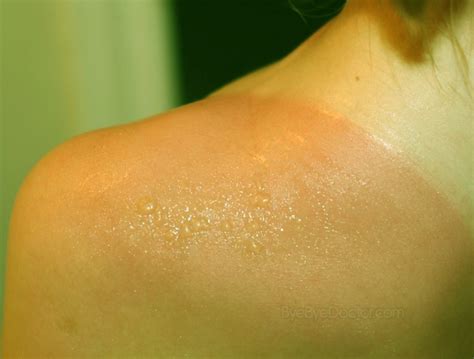 Sunburn Blisters Treatment Pictures Causes Relief