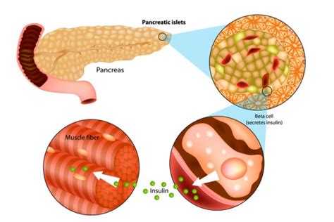 Actually, insulin is produced by beta cells which are essentially produced and located in islet of langerham ( in the endocrine pancreas). What is Type 1 Diabetes?: Overview including symptoms ...