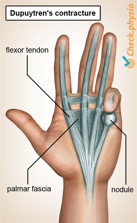 Dupuytrens Contracture Physio Check