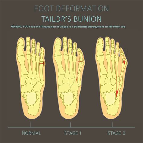 What Is A Foot Bunion Expert Guide To The Best Shoes For Bunions