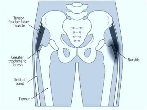 Trochanteric Bursectomy Orthopedic Hip Surgeon Manhattan New York Ny