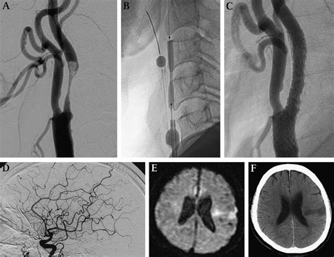 Safety And Effectiveness Of Emergency Carotid Artery Stenting For A