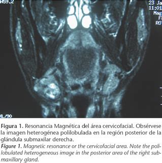 Las glándulas salivales menores se distribuyen por la boca, la faringe y los senos paranasales, en un número aproximado de 500 a 1.000(1). Adenocarcinoma ex adenoma pleomorfo de glándula submaxilar