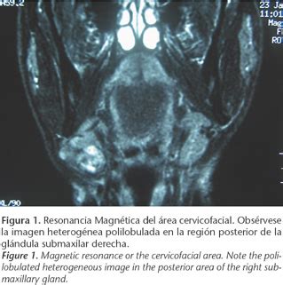 Sintomi adenoma pleomorfo adenoma pleomorfo è una condizione dolorosa che richiede una grande quantità di tempo per trasformarsi in sintomi evidenti. Adenocarcinoma ex adenoma pleomorfo de glándula submaxilar