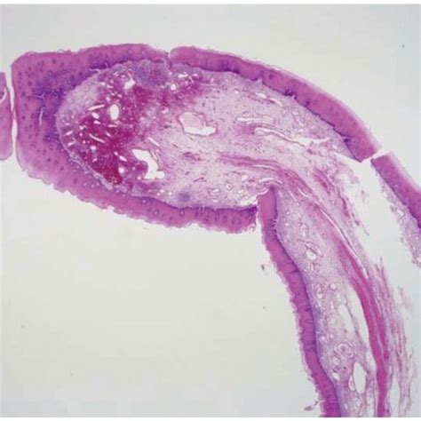 Histopathological Features Of The Fibrovascular Polyp The Core Of The