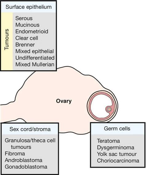Pathology Of Ovarian Tumors Quick Review Epomedicine