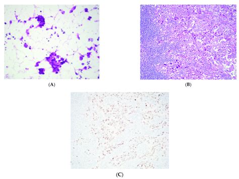 Metastatic Lung Adenocarcinoma A Thymic Smear Showing Overtly Download Scientific Diagram